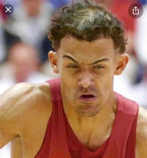 trae young hairline